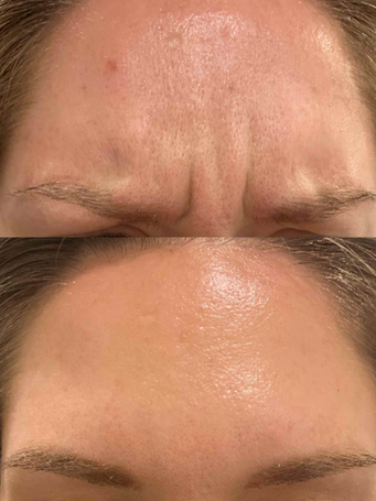 Two images of a Rejuvenation by Vienna clients brow pre and post wrinkle treatment.