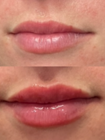 Pre and post Dermal Filler treatment of Rejuvenation by Vienna clients lips.
