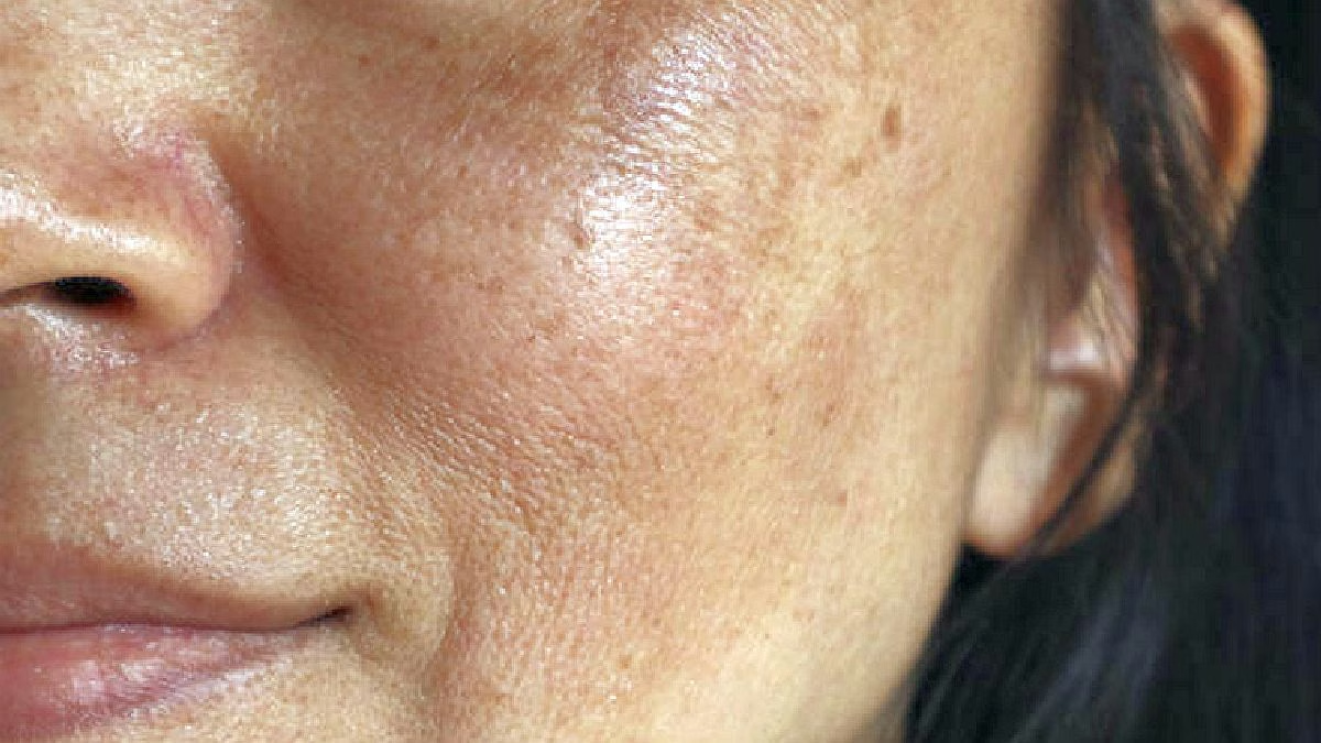 Melasma