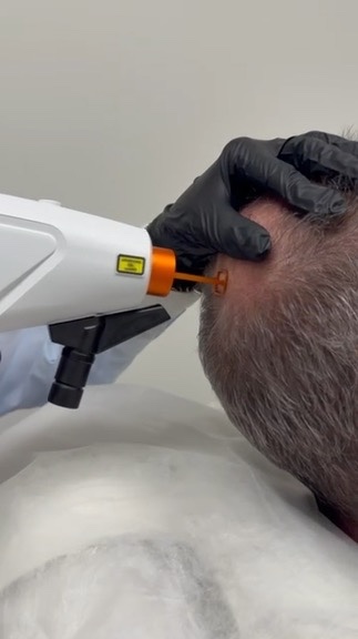 Tratamiento capilar con LASER Prodeep