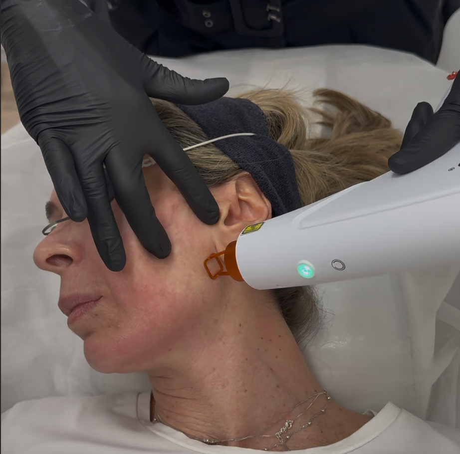 Tratamiento facial con LASER Prodeep