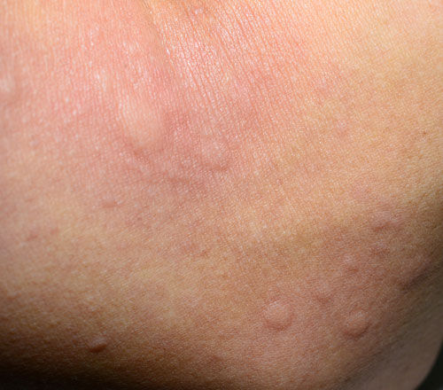 Contact Dermatitis.jpeg