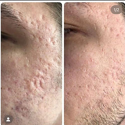 Plasma skin tightening treatment