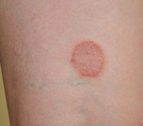 tinea-infections.jpeg