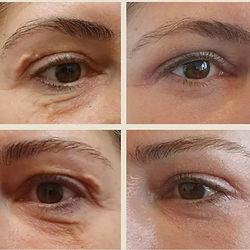 Non-invasive facelift procedure