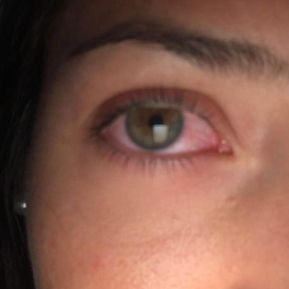 We Accept Emergencies like Red Eyes.