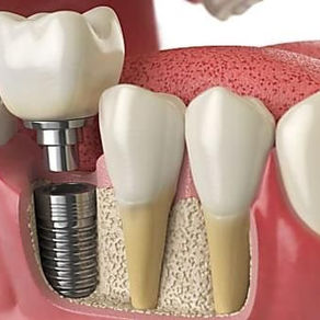 Tot ce trebuie sa stii despre implantul dentar