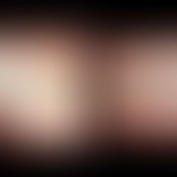 Rezultate uimitoare cu aparatul dentar Invisalign Lite 