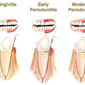Ce este boala parodontala? 