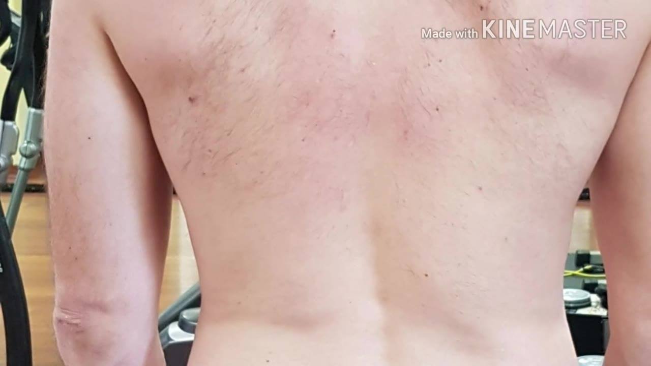 Amélioration de la scoliosis