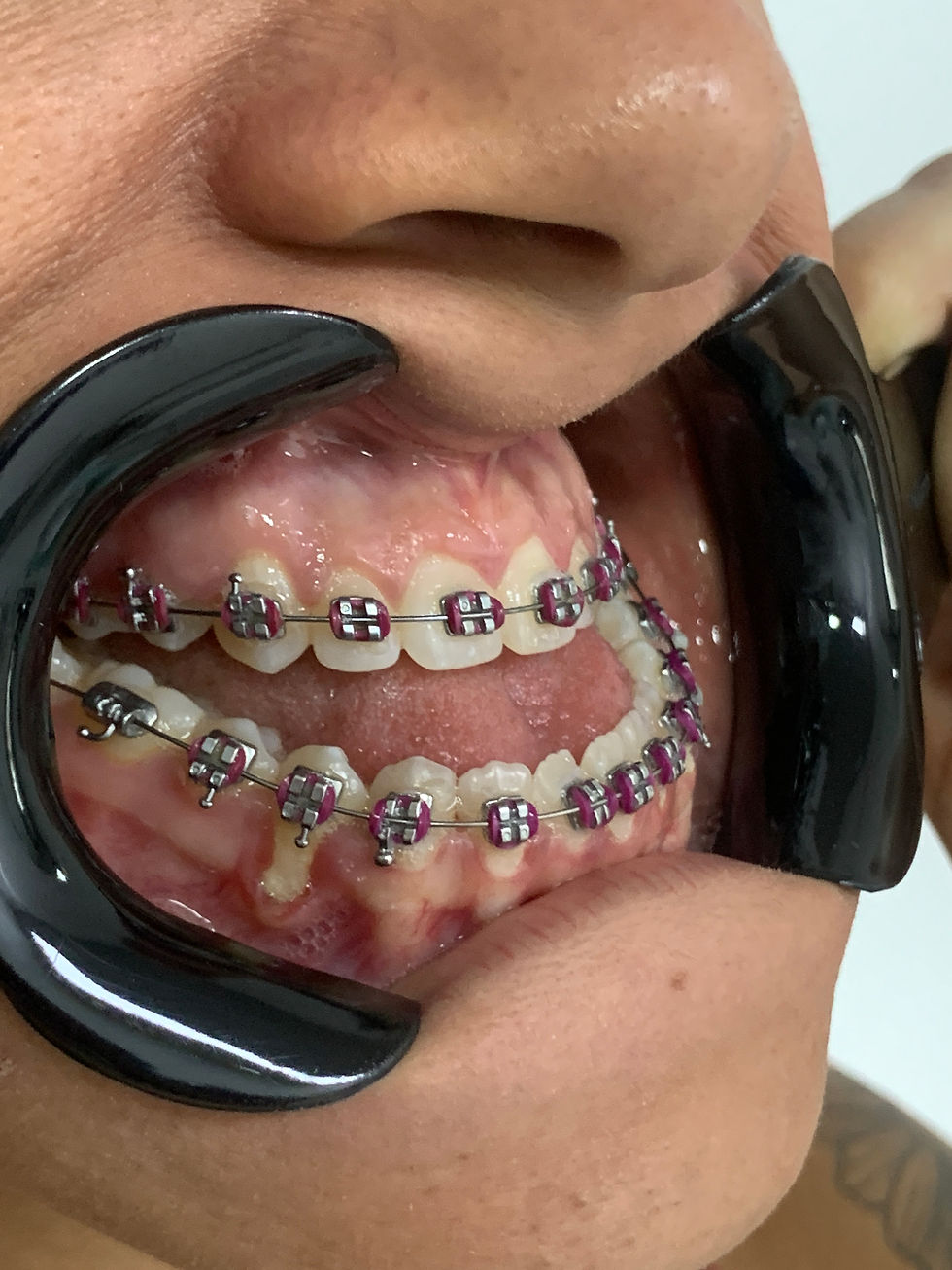 Cirurgia Ortognática