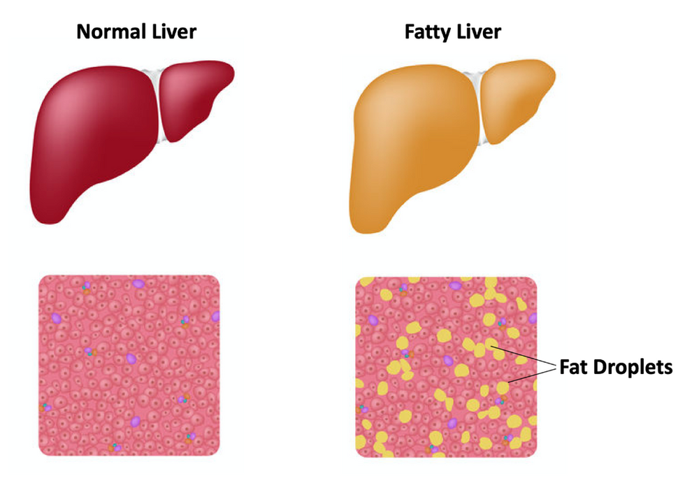 Fatty Liver When Food Has the Power to Reverse Disease by Sara Bowling, MD