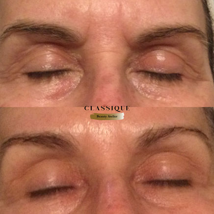 Anti Aging - Microneedling 2.jpg