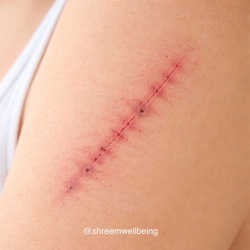 Integrating Scarwork with Craniosacral Therapy For Holistic Healing