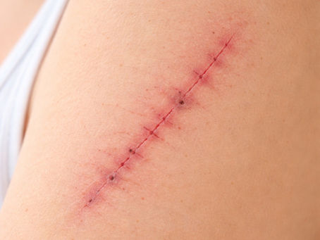 Integrating Scarwork with Craniosacral Therapy For Holistic Healing