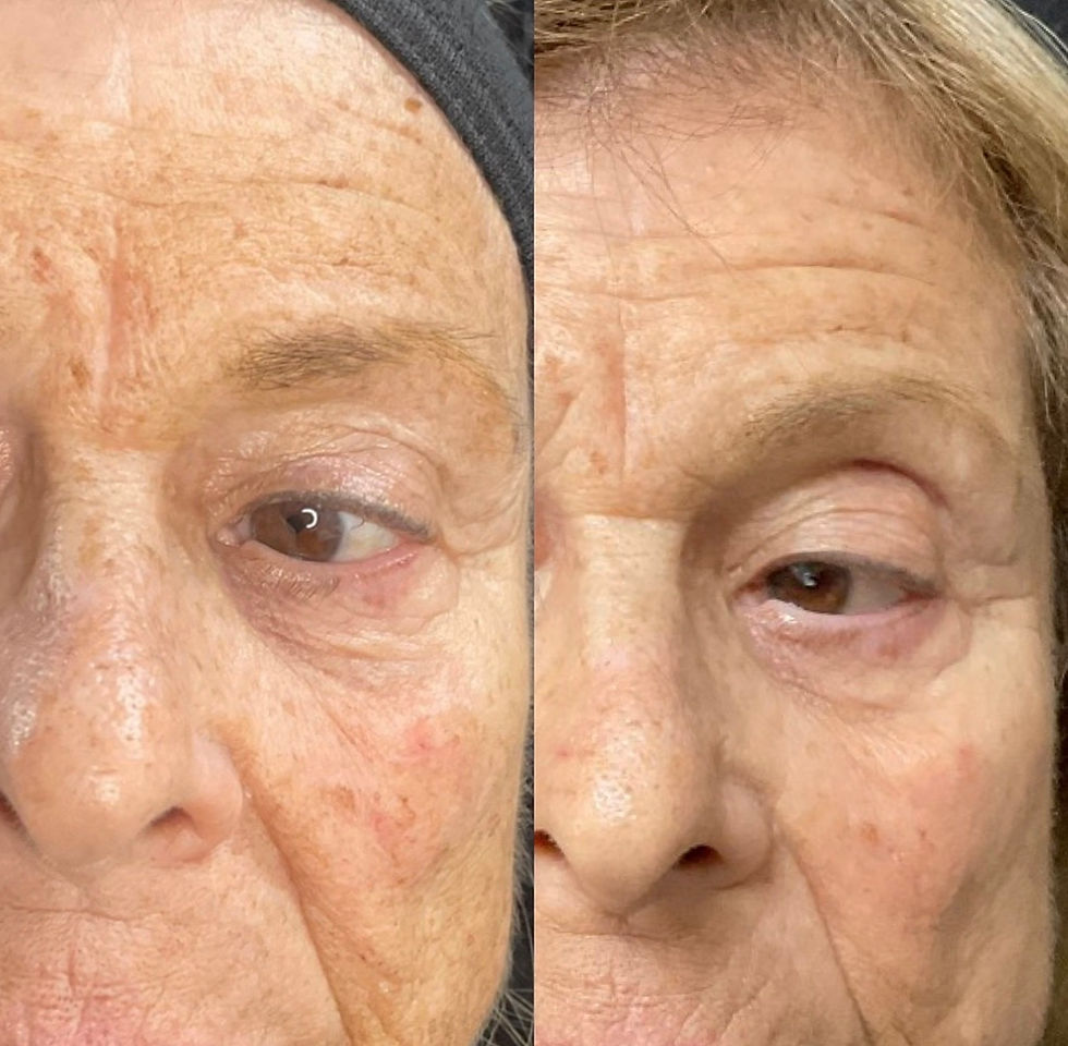 Before & After Laser Treatment Results - Eyes