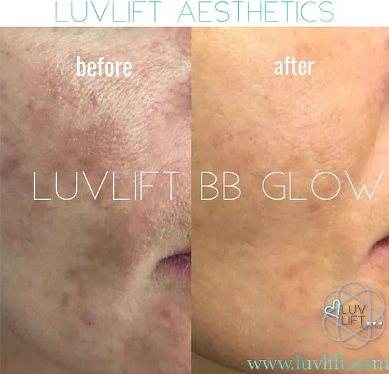 Bb Glow Semi Permanent Foundation Luvlift Aesthetics Temecula