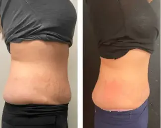 Before & After Cryoskin