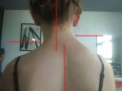 scoliose et appareil dentaire, somatopathie