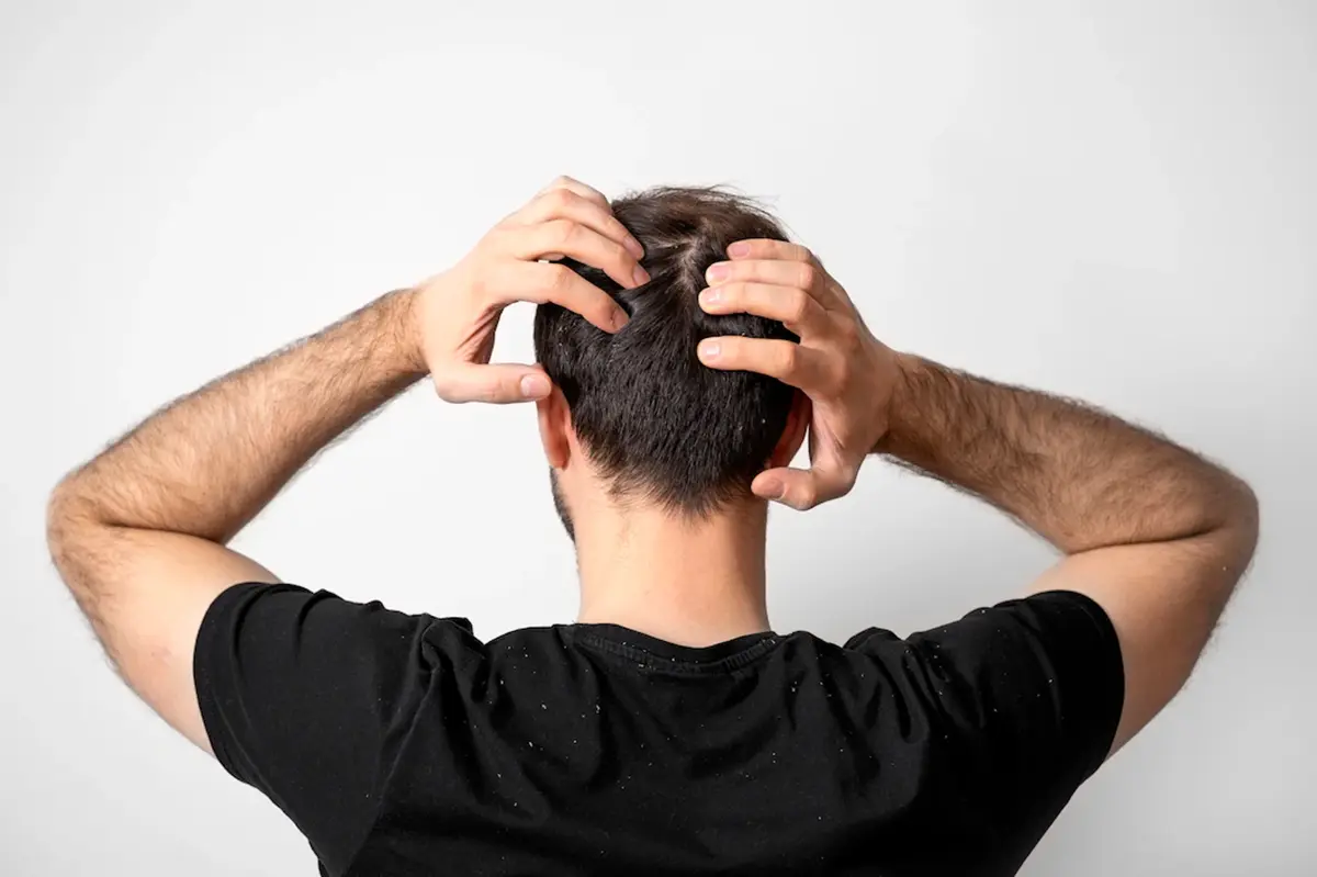Dandruff Treatment for Men 