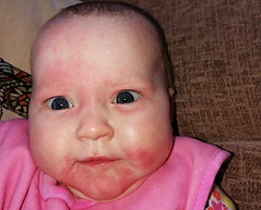 allergy egg face.jpg
