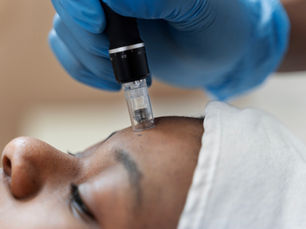 Microneedling for Rejuvenated, glowing skin - Benefits and results