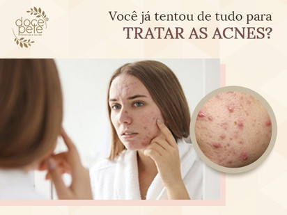 Você já tentou de tudo para tratar as acnes?