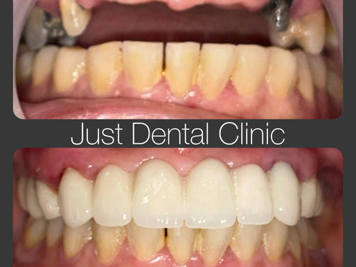 Zirconia Bridge