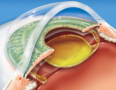 Lente Intraocular.jpg