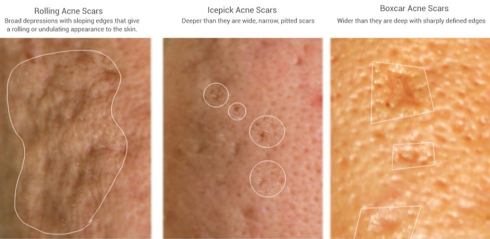 Types of acne scarring that can be treated at Sanctuary Skin in Virginia Beach