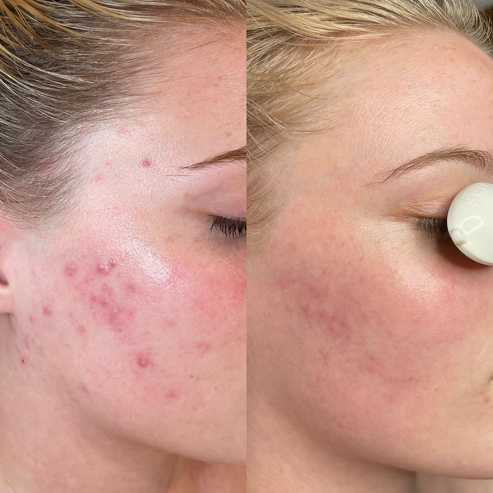 Before and after acne facial at Sanctuary Skin in Virginia Beach.