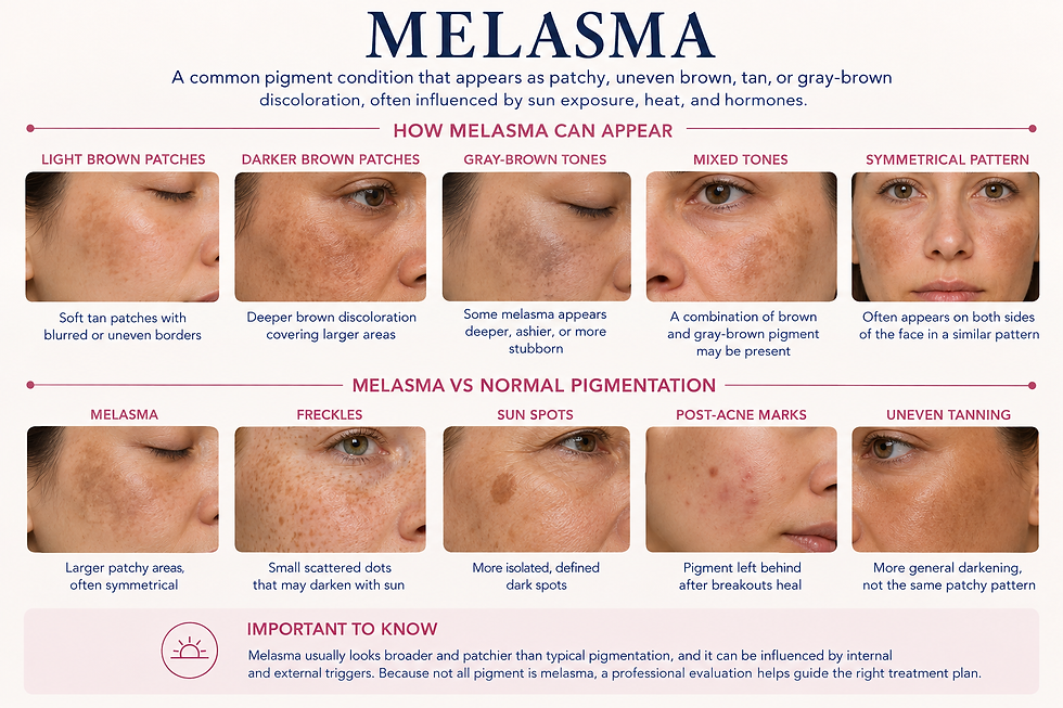 Melasma types and how to identify melasma