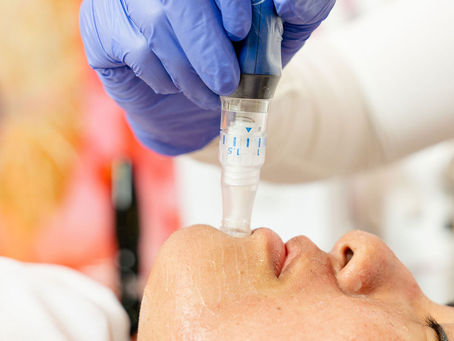 Microneedling and chemical peels to improve skin health