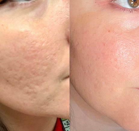 SkinPen microneedling in Virginia Beach