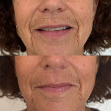 Collagen induction therapy Virginia Beach