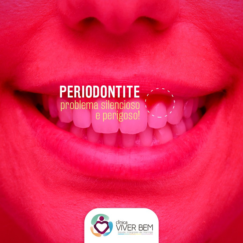 periodontite inflamação na gengiva