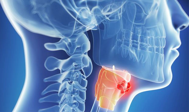 Tumores de cabeza y cuello