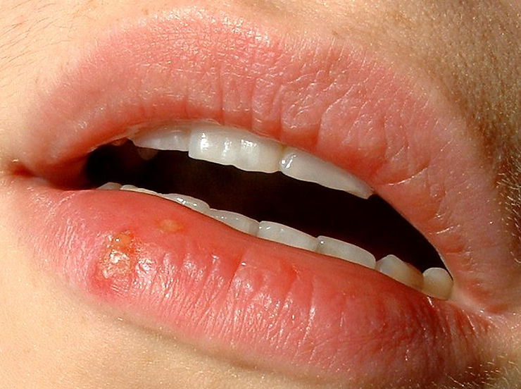 Labio con vesículas agrupadas típicas de infección por herpes simple.