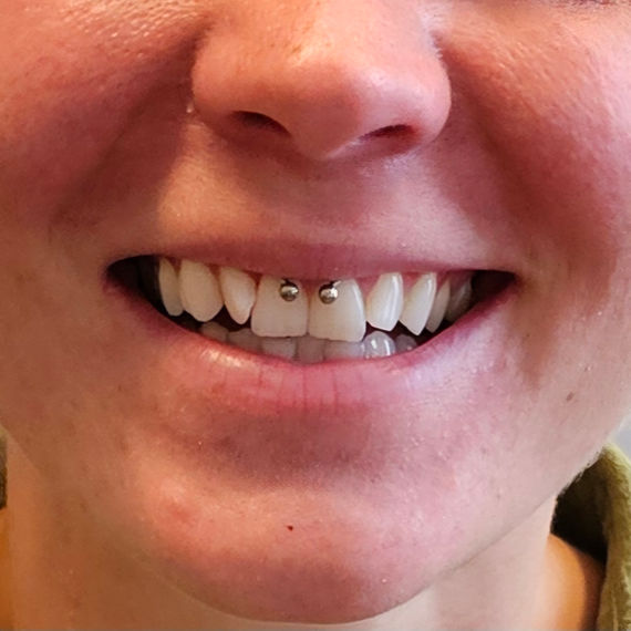 Smiley piercing
