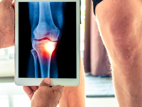 A picture of a doctor's arm holding up x-ray of a broken knee. Doctor is holding the x-ray in front of patient's knee who is standing before him.