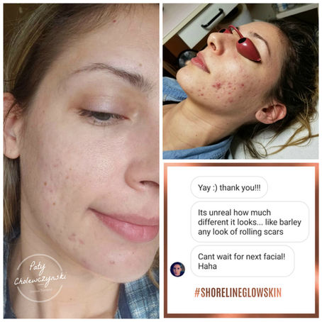 Acne Care in Kitchener- Waterloo