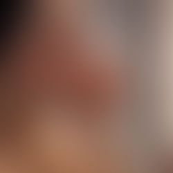 Understanding Rosacea: A Comprehensive Guide