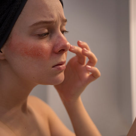 Understanding Rosacea: A Comprehensive Guide