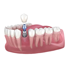 Single-Tooth-Dental-Implant_edited.png