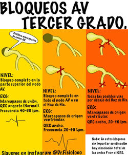 Bloqueos AV tercer grado