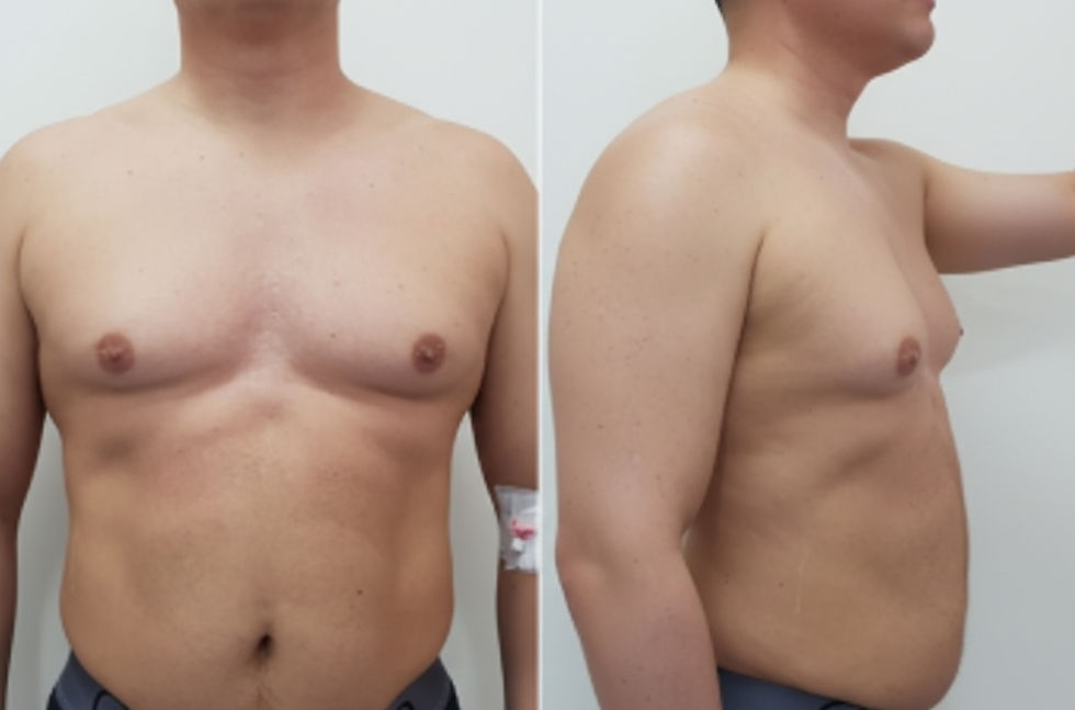 Does Working Out Get Rid of Gynecomastia