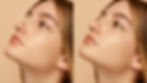 Side-by-side comparison of a woman’s nose before and after rhinoplasty revision, illustrating subtle changes observed 10 years post-surgery.