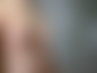 Gynecomastia Post Surgery Swelling