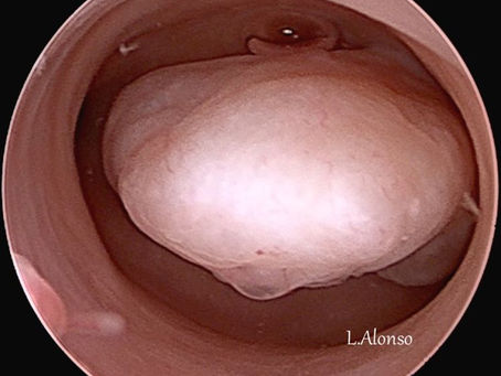 O que é pólipo uterino?