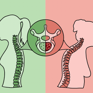 Osteoporosis: A Global Pandemic For Postmenopausal Women
